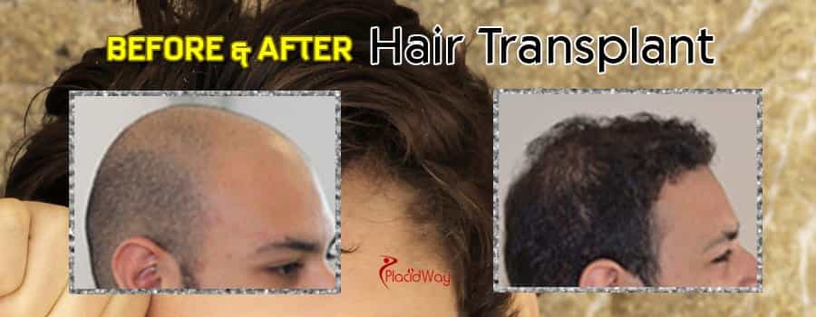 Before and After Image of Hair Transplant in India